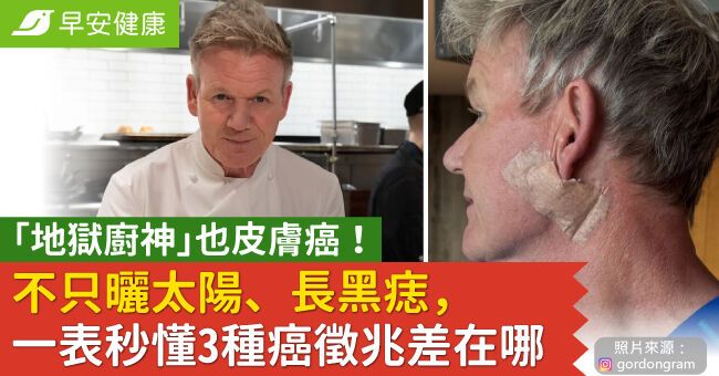 「地獄廚神」也皮膚癌!不只曬太陽、長黑痣,一表秒懂3種癌徵兆差在哪