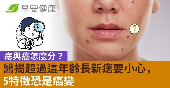 痣與癌怎麼分?醫揭超過這年齡長新痣要小心,5特徵恐是癌變